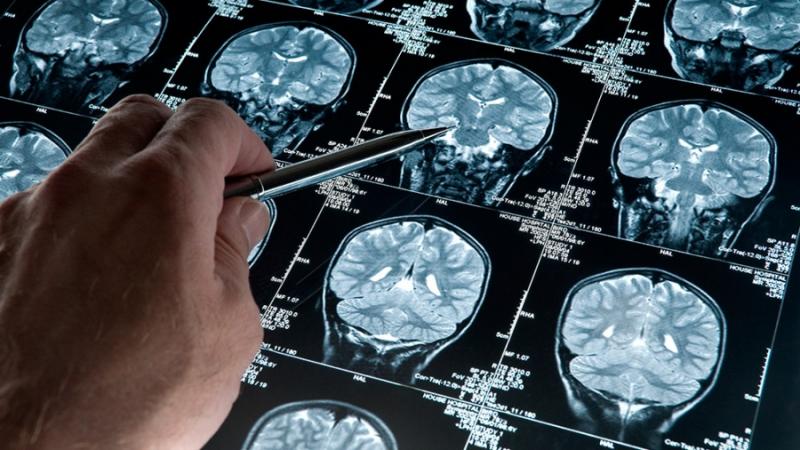 Alzheimer, la enfermedad que ahora puede ser detectada 20 años antes de la aparición de síntomas
